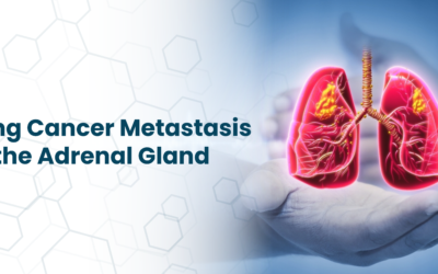 Lung Cancer Metastasis to the Adrenal Gland