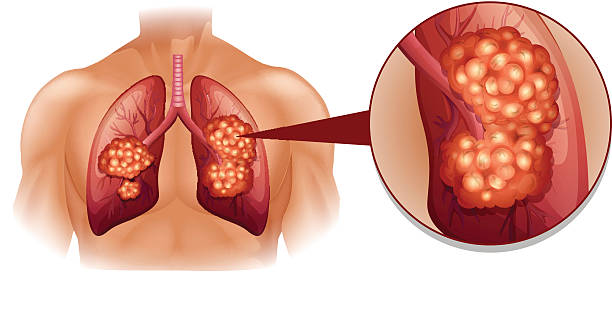 Lung Cancer