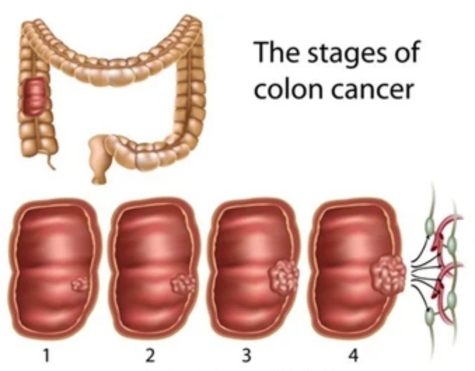 Colon Cancer