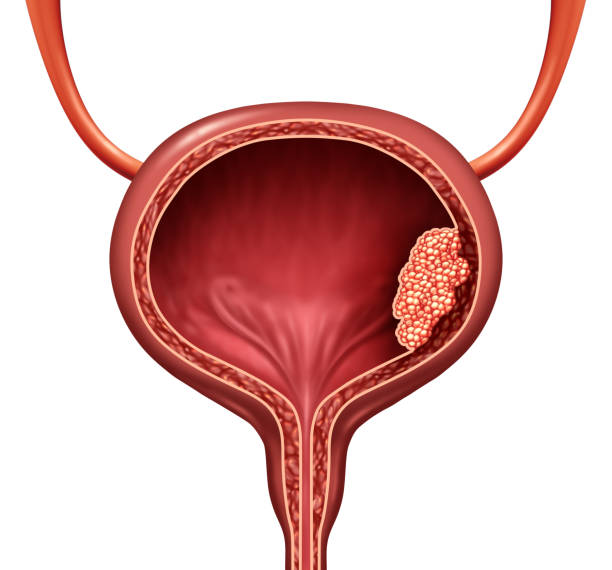 Bladder Cancer