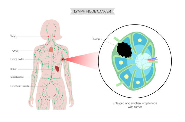 Lymphoma