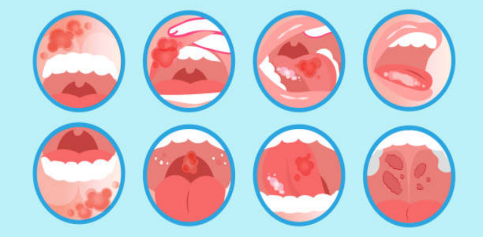 Causes and Location of Oral Precancerous Lesions